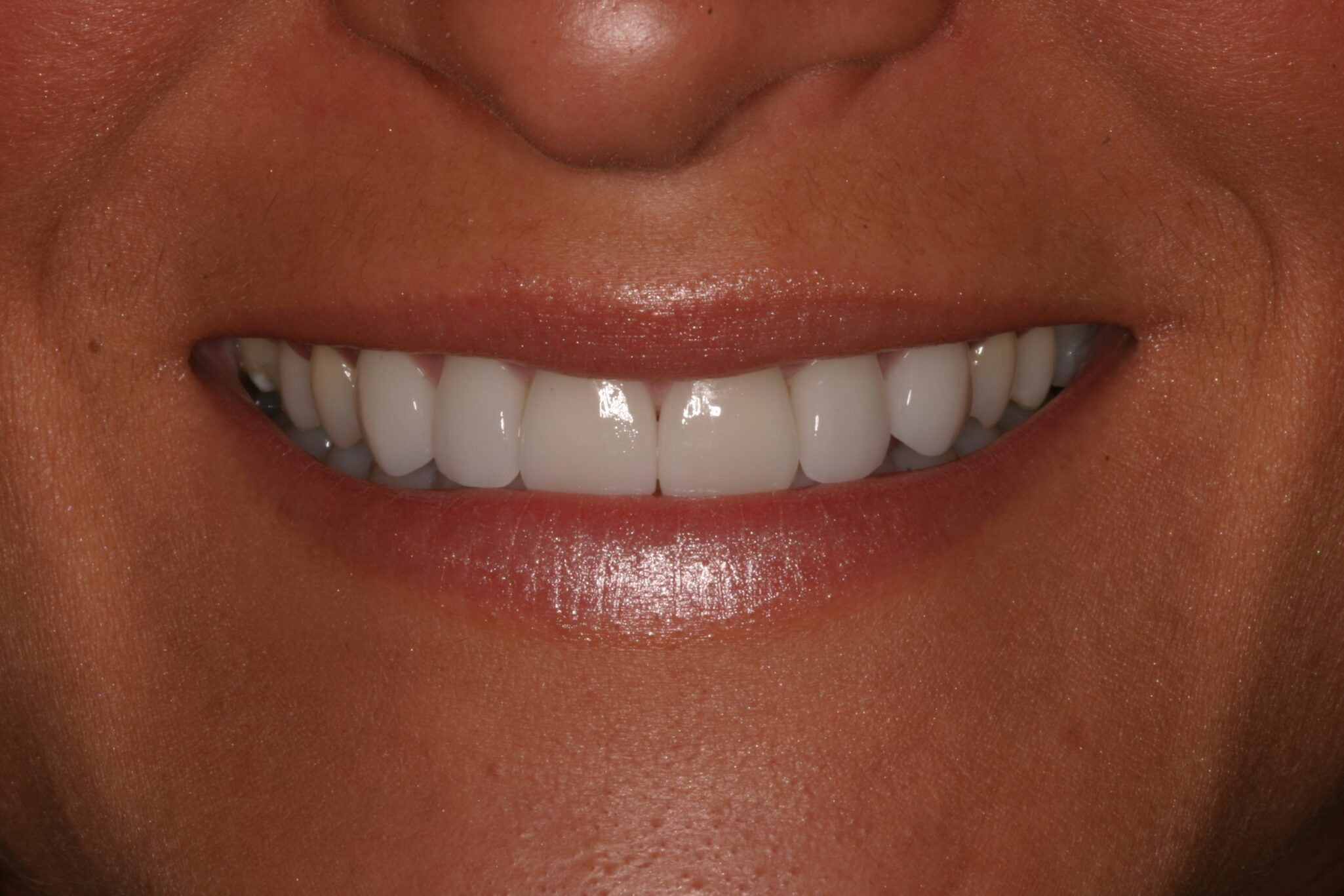 CS-Smile-After CS-Smile-After