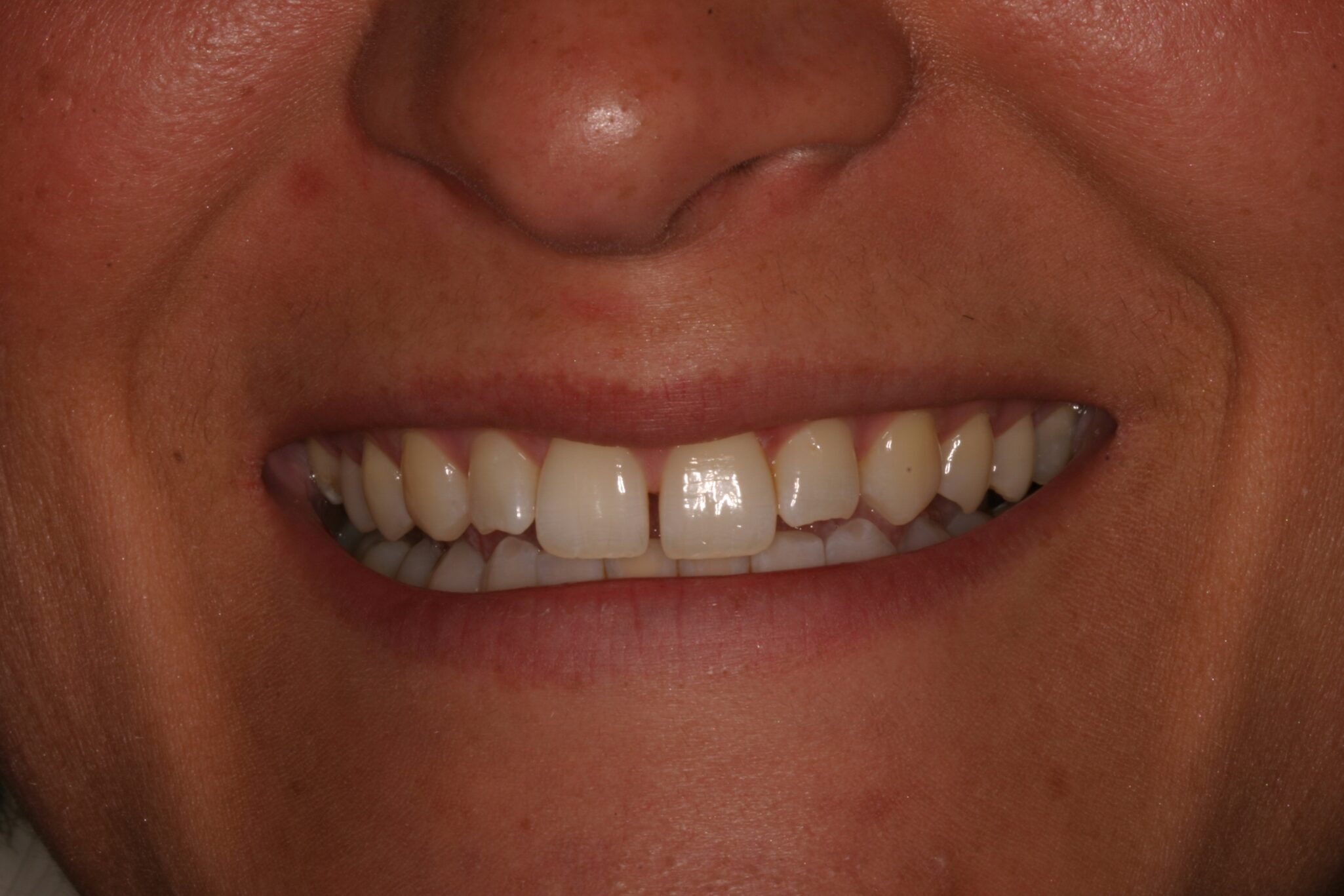 CS-Smile-B4 CS-Smile-B4