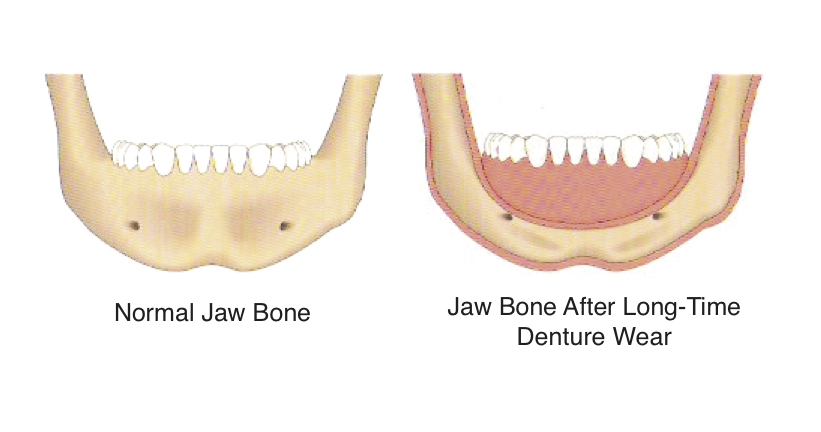 Missing Teeth What Happens To The Jaw Bone Without Tooth Roots Ban