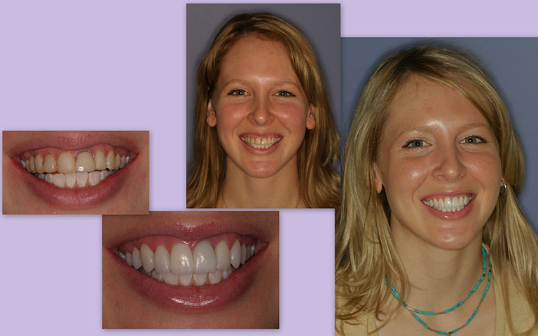 Patient Photo Before and After Treatment