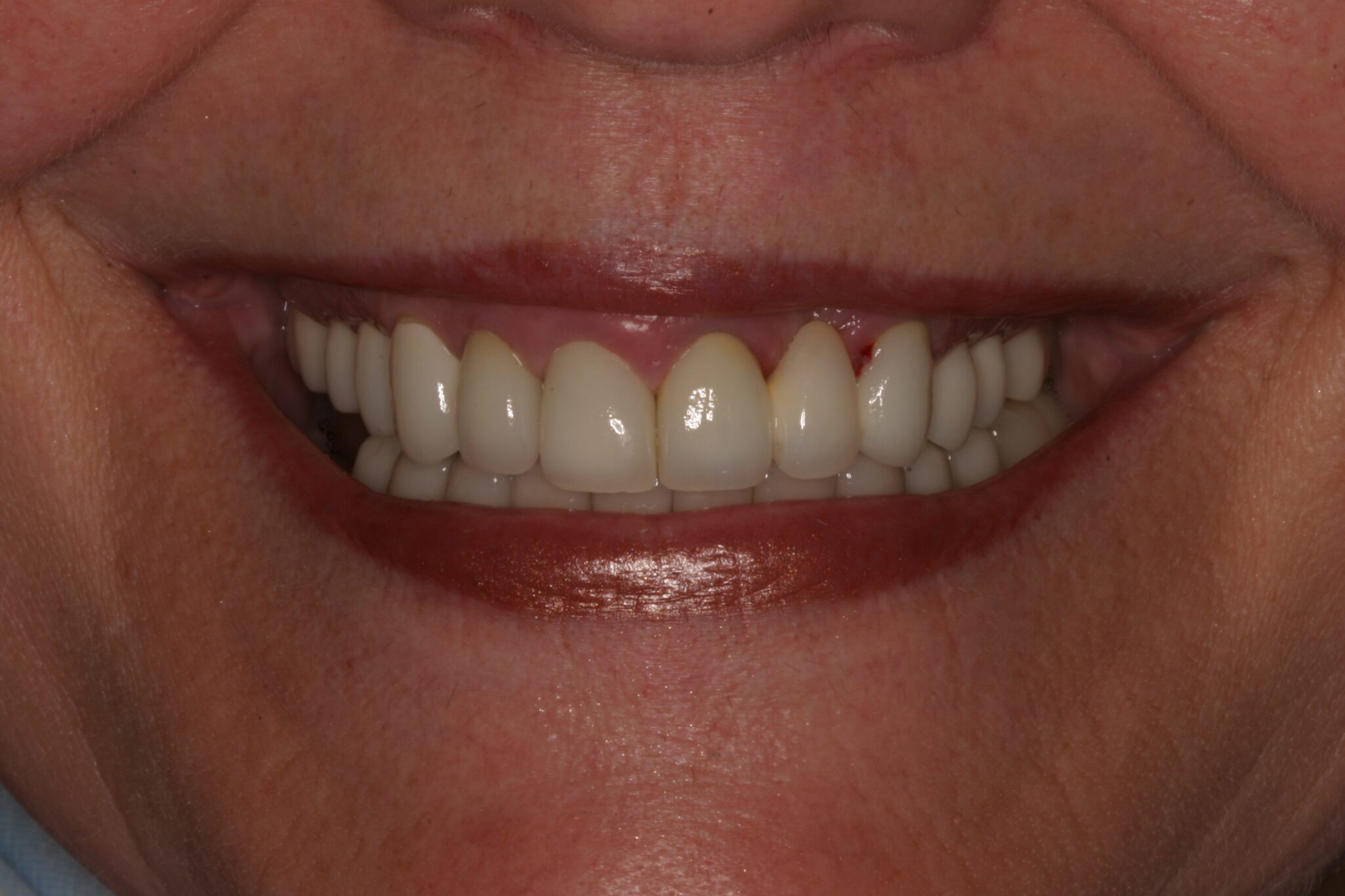 EF-Smile-After