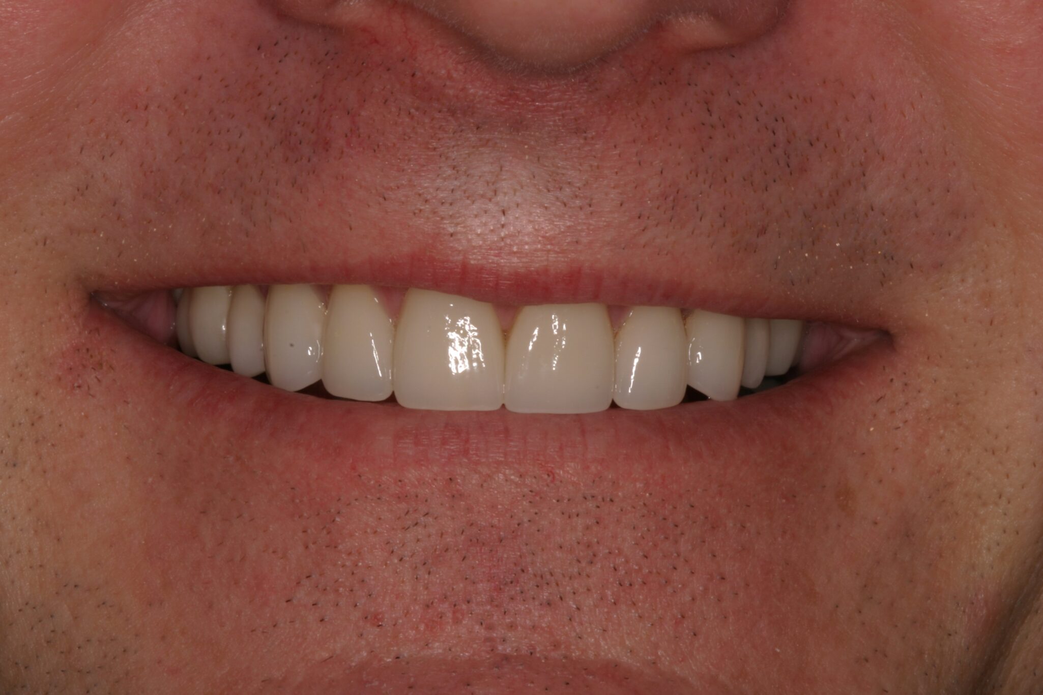 GO-Smile-After