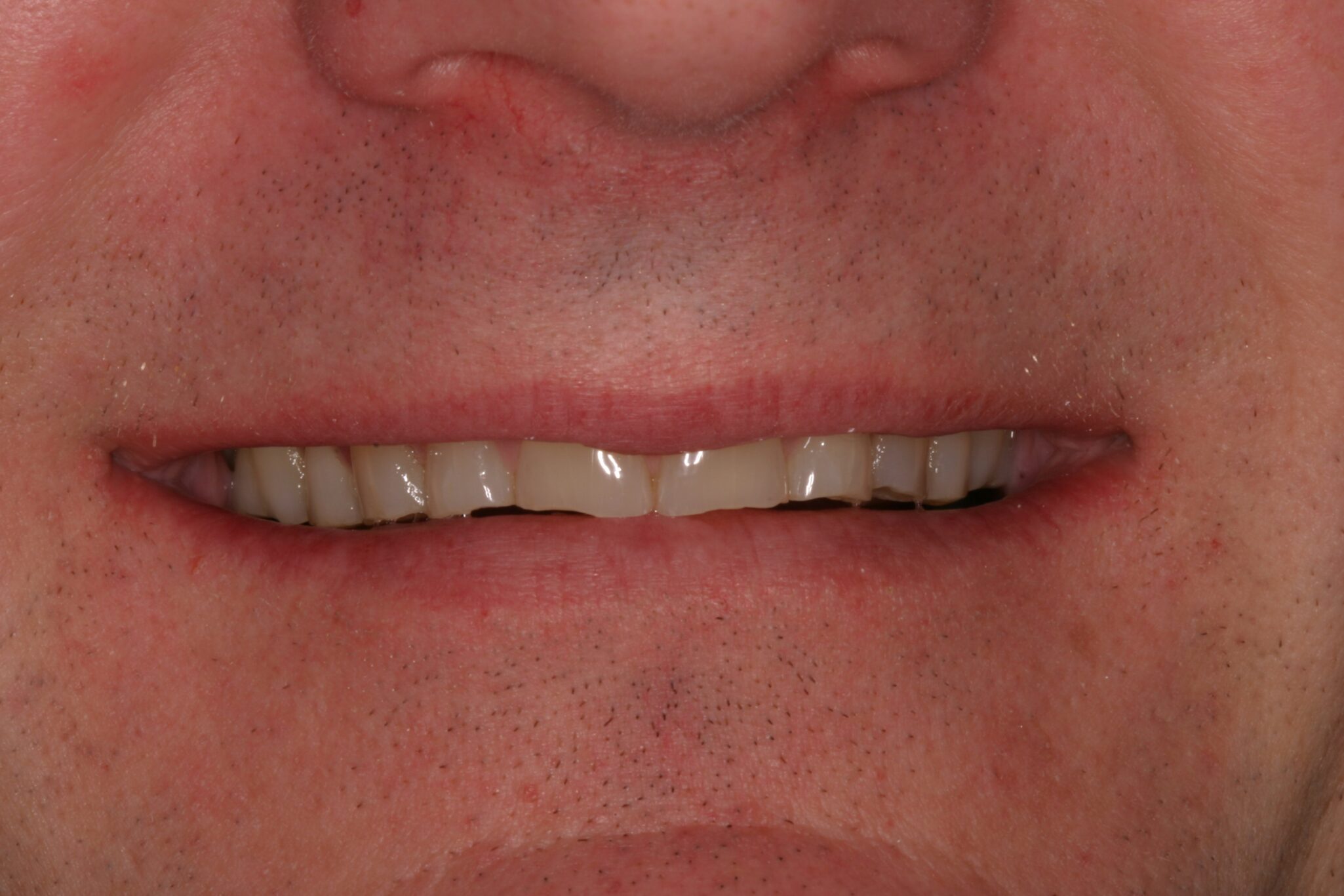 GO-Smile-B4