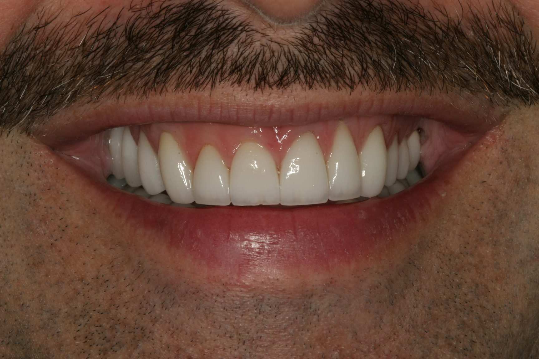 JA-Smile-After