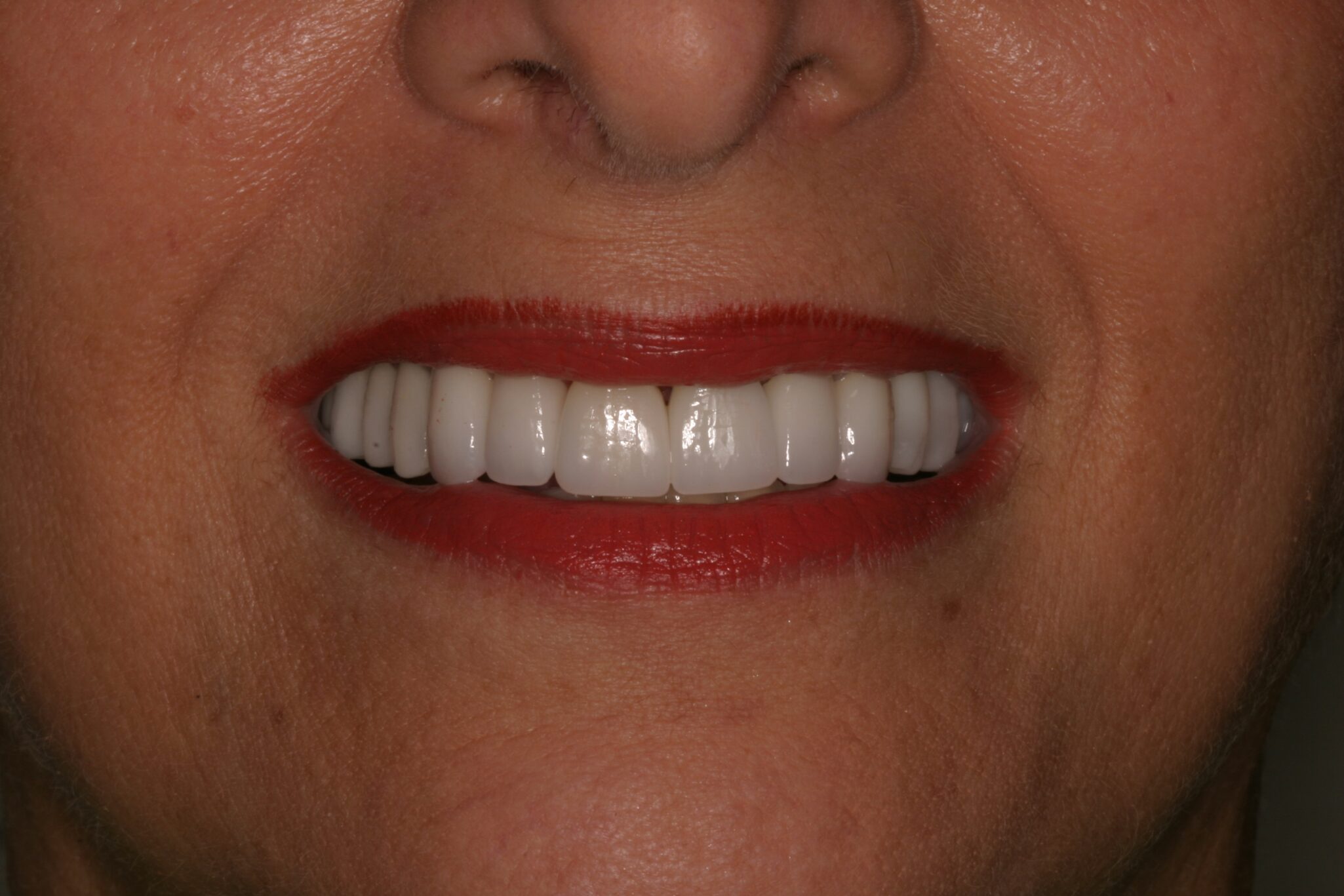 MW-Smile-After