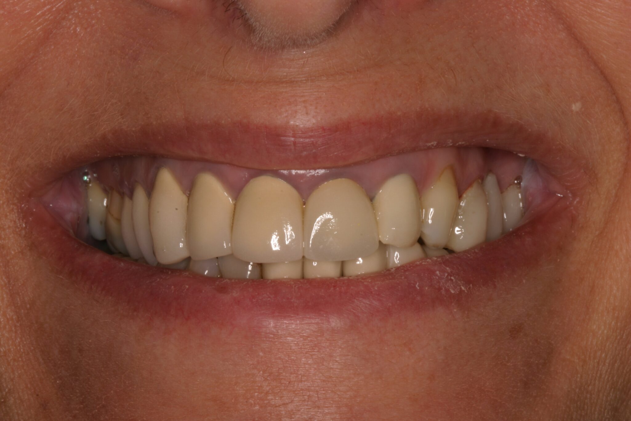 MW-Smile-B4