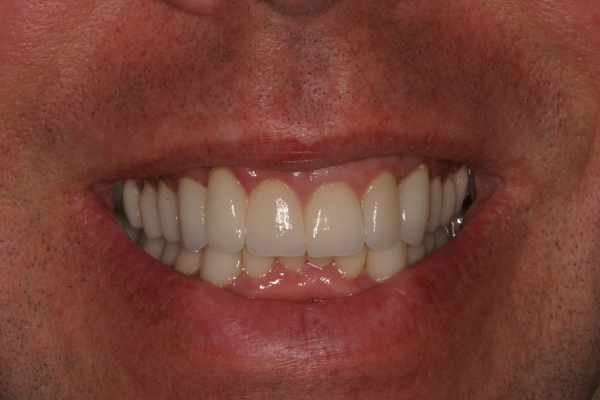 TE-Smile-After