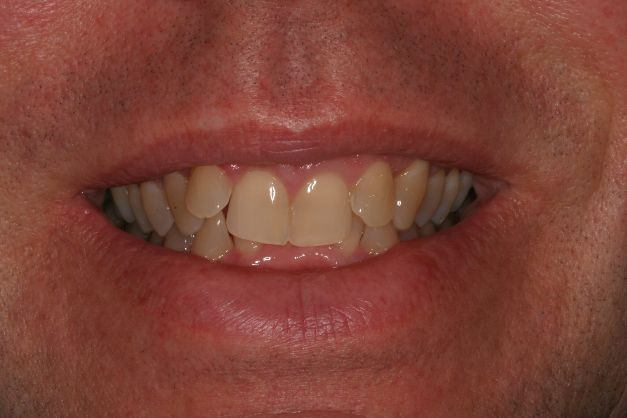 TE-Smile-B4